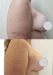 Mastopexia - Dr. Matias Llabres