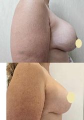 Recambio de Protesis - Dr. Matias Llabres