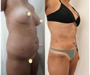 Liposucción - Dr. Matias Llabres