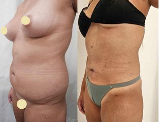 Liposucción - Dr. Matias Llabres