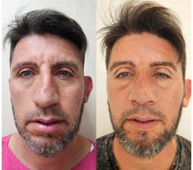 Rinoplastia - Dr. Matias Llabres