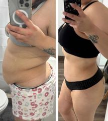 Abdominoplastia - Dr. Matias Llabres