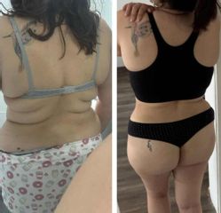 Abdominoplastia - Dr. Matias Llabres