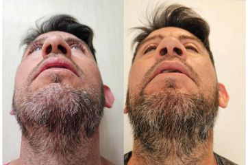 Rinoplastia - Dr. Matias Llabres