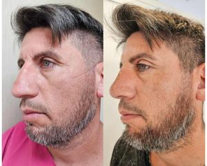 Rinoplastia - Dr. Matias Llabres