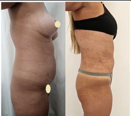 Liposucción - Dr. Matias Llabres