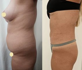 Liposucción - Dr. Matias Llabres