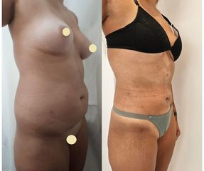 Liposucción - Dr. Matias Llabres