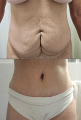 Abdominoplastia - Dr. Matias Llabres