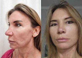 Lifting Facial - Dr.Matias Llabres