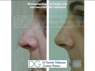Rinoplastia - Dr. Damián Galeazzo