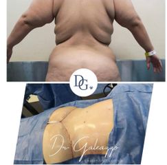 Dermopilectomia 360º abdomen y espalda. Dr Damian Galeazzo