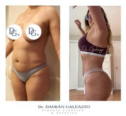 Lipoescultura. Dr Galeazzo