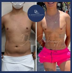 Lipoescultura con marcación Abdominal. Dr Galeazzo.