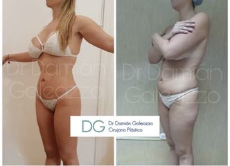 Liposucción - Dr. Damián Galeazzo