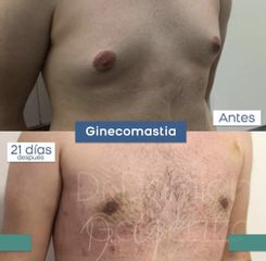 Ginecomastia  - Dr. Damián Galeazzo