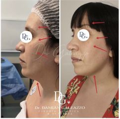 Rejuvenecimiento facial - Dr. Damián Galeazzo