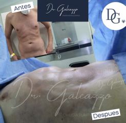 Lipoescultura - Dr. Damián Galeazzo