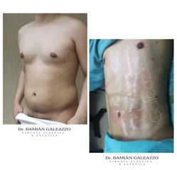 Marcación abdominal - Dr. Damián Galeazzo