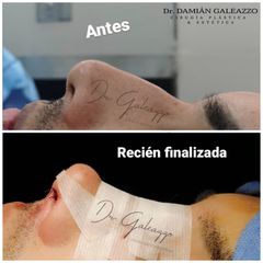Rinoplastia Sin cicatriz. - Dr. Damián Galeazzo