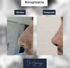 Rinoplastia - Dr. Damián Galeazzo