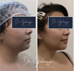 Liposucción de papada Renuvion Facial - Dr. Damián Galeazzo