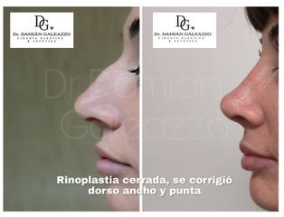 Rinoplastia- Dr Galeazzo