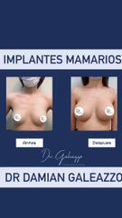 Aumento mamario - Dr Damián Galeazzo y Equipo