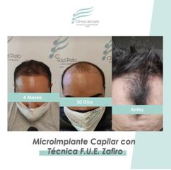 Implante Capilar - Dr. Damián Galeazzo y Equipo