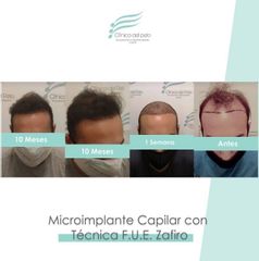 Microimplante Capilar - Dr Galeazzo