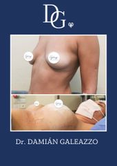 Aumento mamario - Dr. Damián Galeazzo y Equipo