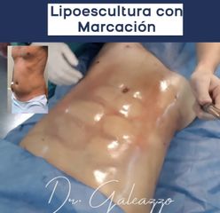 Lipoescultura - Dr. Damián Galeazzo y Equipo