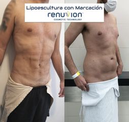 Lipoescultura - Dr. Damián Galeazzo y Equipo