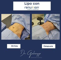 Liposucción - Dr. Damián Galeazzo y Equipo