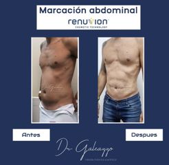 Lipoescultura con Marcación abdominal - Dr. Damián Galeazzo y Equipo