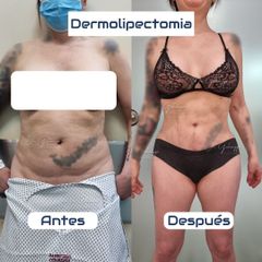 Dermolipectomía - Dr. Damián Galeazzo y Equipo