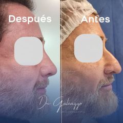 Rinoplastia - Dr. Damián Galeazzo y Equipo