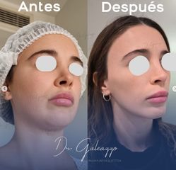 Rejuvenecimiento facial - Dr. Damián Galeazzo y Equipo