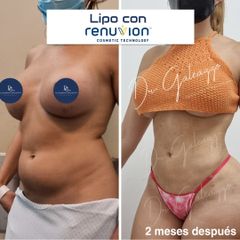 Lipo con RENUVION - Dr. Damián Galeazzo y Equipo