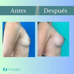 Aumento mamario - Clinica Essenza