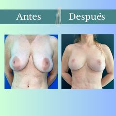 Reducción mamaria - Clinica Essenza