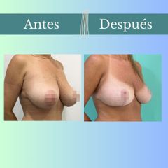 Reducción mamaria - Clinica Essenza