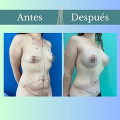 Abdominoplastia - Clinica Essenza