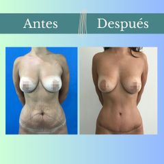 Abdominoplastia - Clinica Essenza