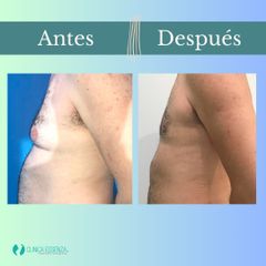 Ginecomastia - Clinica Essenza
