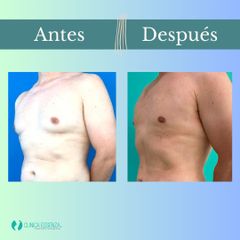 Ginecomastia - Clinica Essenza