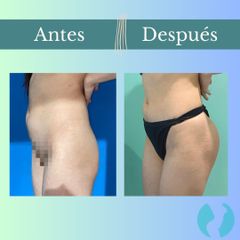Aumento glúteos - Clinica Essenza