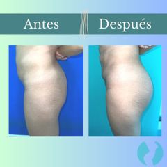 Aumento glúteos - Clinica Essenza