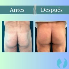 Aumento glúteos - Clinica Essenza