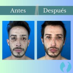 Otoplastia - Clinica Essenza